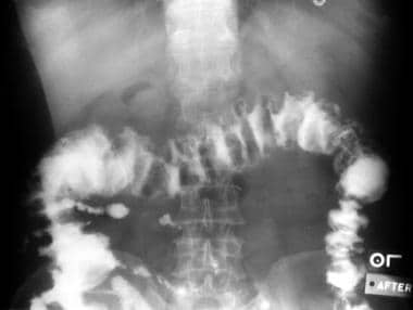 Clostridioides (Clostridium) Difficile Colitis. Ba