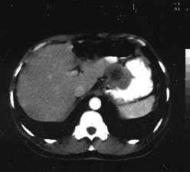 Benign gastric tumors. CT scan of the abdomen show