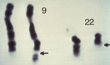 The Philadelphia chromosome, which is a diagnostic