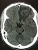 Brain Abscess