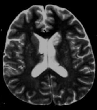 Axial T2-weighted magnetic resonance image shows c