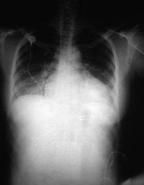 Hypertension. Anteroposterior x-ray from a 28-year