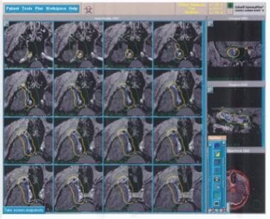 Gamma knife radiosurgery plan. This patient presen