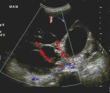 Transabdominal sonogram of a multilocular right ov