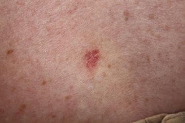 Basal Cell Carcinoma: Practice Essentials, Background 