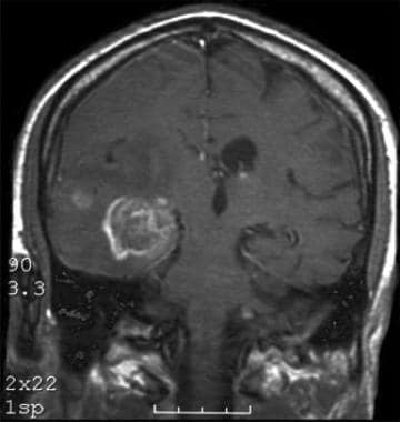 A T1-weighted coronal MRI with intravenous contras