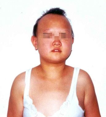 Photograph of a 16-year-old girl with complicated 