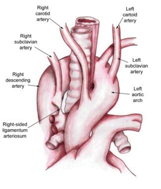 Left aortic arch with right descending aorta and r