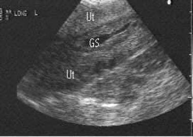 This image shows an endovaginal longitudinal view 