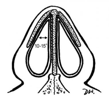 Cross-sectional area of the nasal cavity at the mi