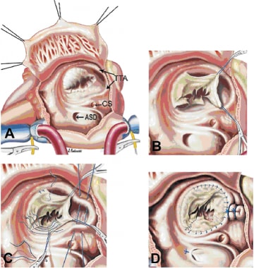 Ebstein Malformation Surgery Treatment & Management: Medical Therapy ...