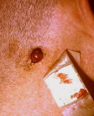 papilloma vs granuloma