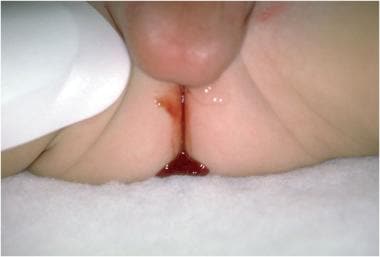 Pediatric Small Bowel Obstruction. The clinical ph