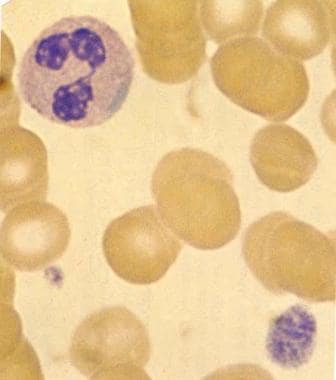 Blood smear (original magnification ×2000) in pati