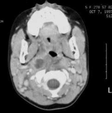 CT scan with contrast demonstrates a 2-cm low-atte