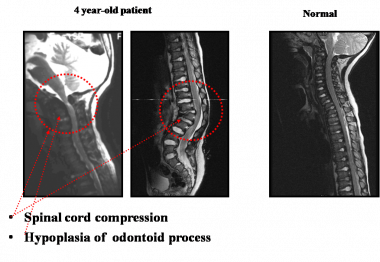 MRI of the cervical spine in a patient aged 4 year