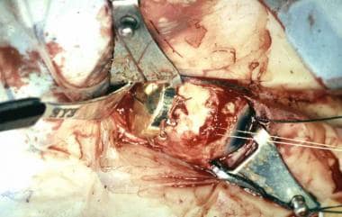 Intraoperative photograph showing placement of a r