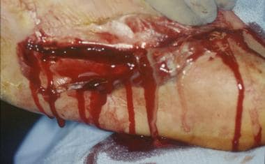 Infected diabetic ulceration. Intraoperative view 