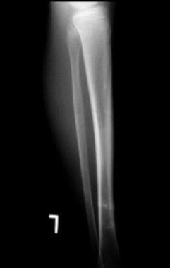 Lateral radiograph of the tibia demonstrating a pe