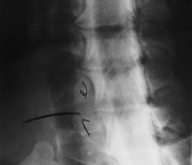 Myelogram of cervical herniated disk. Filling defe
