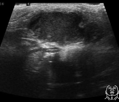 Ultrasound image shows a midline infrahyoid uniloc