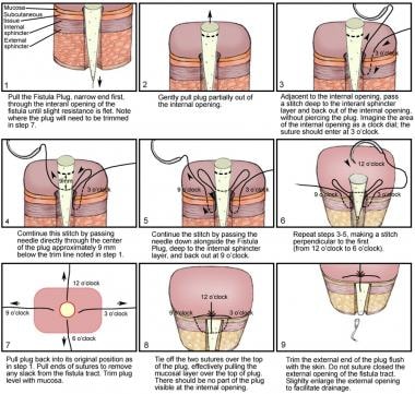 anal fistula surgery