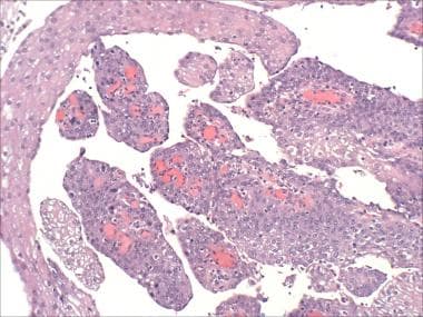 squamous papilloma histology