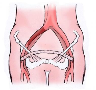 Femoral-femoral bypass configuration. 