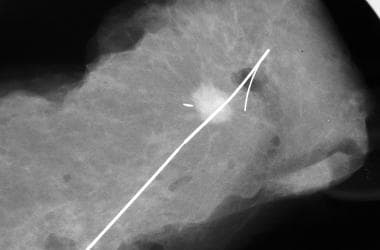 Breast biopsy with needle localization. The specim