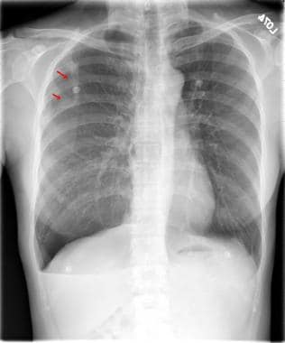Chest radiography of patient with spontaneous righ