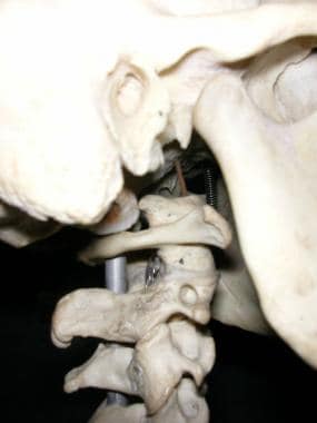 Craniocervical articulations. 