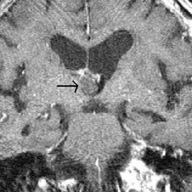 Coronal magnetic resonance image shows a colloid c