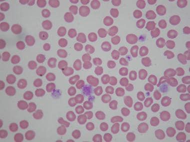 idiopathic thrombocytopenic purpura smear