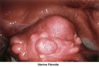 Infertility. Uterine fibroids. Image courtesy of J