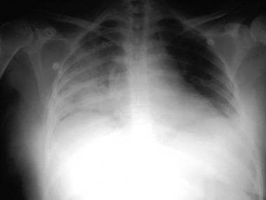 患者的胸部射线照片与巨大的aspirat