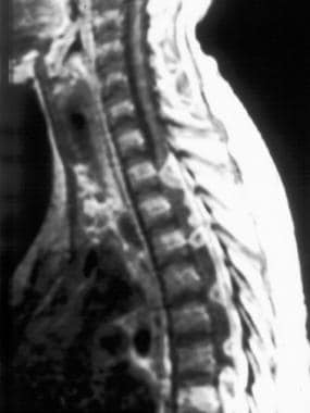 Sagittal T1-weighted contrast-enhanced MR image of