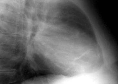 Constrictive pericarditis. Chest radiograph latera