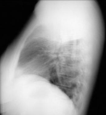 Lateral chest radiograph demonstrating a right upp