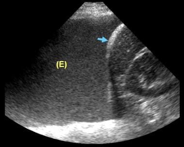 Ultrasonogram of the left lower chest in a male pa