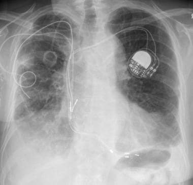 Chest radiograph in a patient with breast cancer s