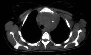 Nonenhanced axial CT scan shows biopsy-proved non-