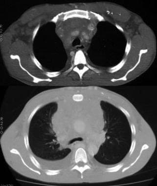 Invasive thymoma. Contrast-enhanced CT scan shows 