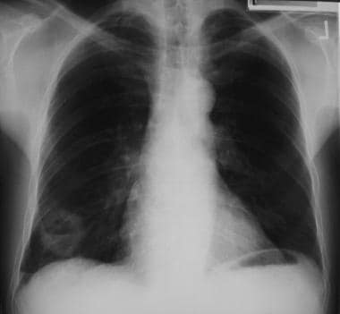 Solitary pulmonary nodule. Cavitating nodule secon
