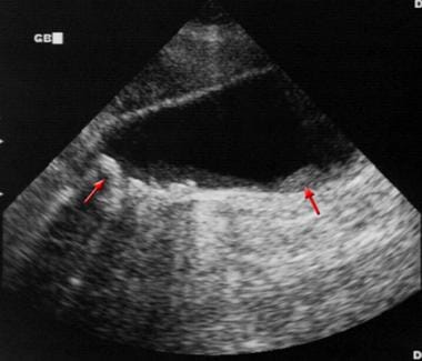 Sagittal sonogram in a 71-year-old woman. This ima