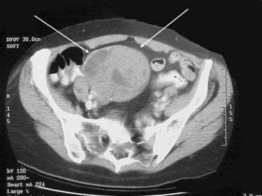 Gastrointestinal stromal tumor (GIST). CT demonstr