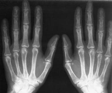 Radiograph of both hands in a patient who also has