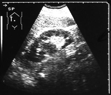 Longitudinal sonogram obtained through the right k