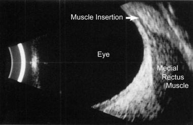B-scan ultrasonogram reveals enlargement of the ex