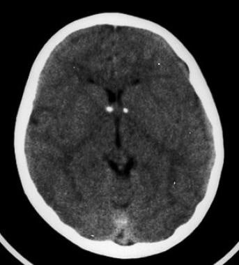 Nonenhanced head CT scan reveals bilateral calcifi