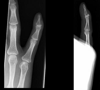 Finger and Thumb Trauma Imaging: Overview, Radiography, Computed Tomography